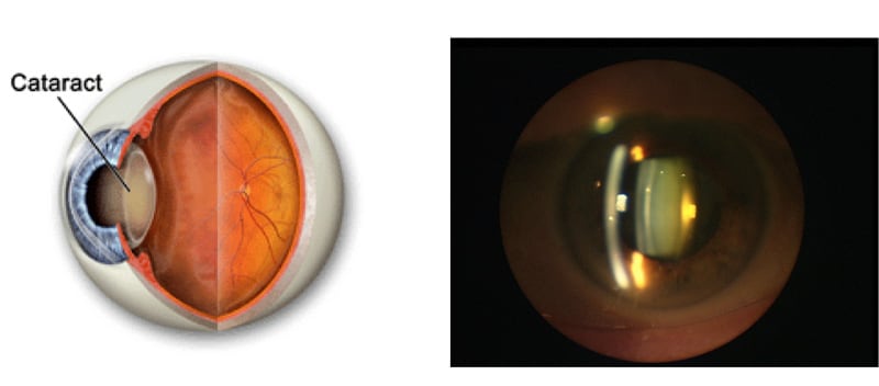 cataracte definition symptomes chirurgien ophtalmologue paris lasik chirurgie refractive oeil laser yeux docteur jean marc ancel ophtalmologue neuilly sur seine paris