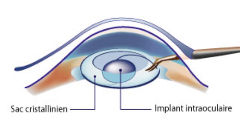 comment se deroule une operation de la cataracte chirurgien ophtalmologue paris lasik chirurgie refractive oeil laser yeux docteur jean marc ancel ophtalmologue neuilly sur seine paris
