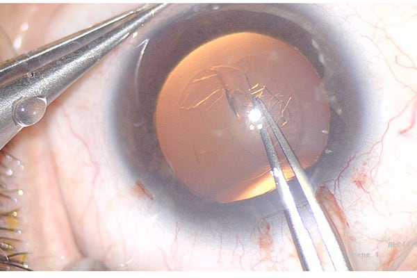 implant cataracte duree de vie chirurgien ophtalmologue paris lasik chirurgie refractive oeil laser yeux docteur jean marc ancel ophtalmologue neuilly sur seine paris 2