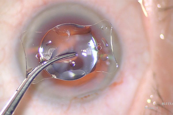 implant multifocal torique remplacement cristallin clair chirurgien ophtalmologue paris chirurgie refractive oeil laser yeux docteur jean marc ancel ophtalmologue neuilly sur seine paris
