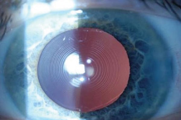 implant multifocal yeux remplacement cristallin clair chirurgien ophtalmologue paris chirurgie refractive oeil laser yeux docteur jean marc ancel ophtalmologue neuilly sur seine paris