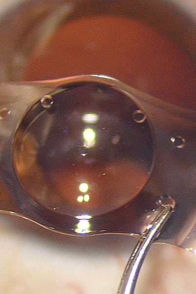 implants intraoculaires refractifs chirurgien ophtalmologue paris chirurgie refractive oeil laser yeux docteur jean marc ancel ophtalmologue neuilly sur seine paris