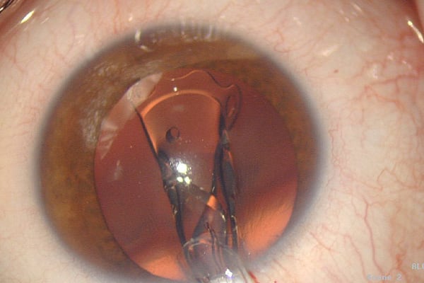 injections implants oculaires multifocaux myopie chirurgien ophtalmologue paris chirurgie refractive oeil laser yeux docteur jean marc ancel ophtalmologue neuilly sur seine paris