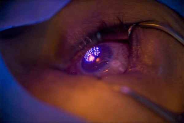 laser excimer cours coperation laser pkr chirurgien ophtalmologue paris lasik chirurgie refractive oeil laser yeux docteur jean marc ancel ophtalmologue neuilly sur seine paris