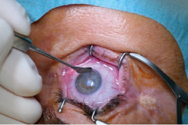 laser pkr douleur chirurgien ophtalmologue paris chirurgie refractive oeil laser yeux docteur jean marc ancel ophtalmologue neuilly sur seine paris