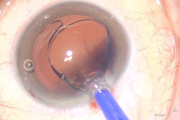 operation cataracte convalescence chirurgien ophtalmologue paris lasik chirurgie refractive oeil laser yeux docteur jean marc ancel ophtalmologue neuilly sur seine paris