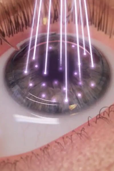 pkr operation des yeux chirurgien ophtalmologue paris chirurgie refractive oeil laser yeux docteur jean marc ancel ophtalmologue neuilly sur seine paris