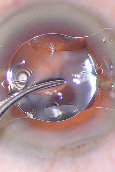 remplacement cristallin oeil chirurgien ophtalmologue paris chirurgie refractive oeil laser yeux docteur jean marc ancel ophtalmologue neuilly sur seine paris