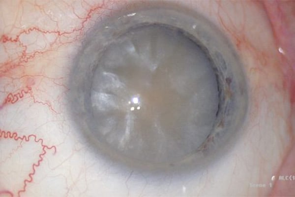 symptome cataracte oeil chirurgien ophtalmologue paris lasik chirurgie refractive oeil laser yeux docteur jean marc ancel ophtalmologue neuilly sur seine paris