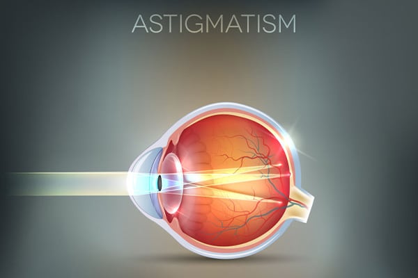 correction astigmatisme fort chirurgien ophtalmologue paris chirurgie refractive oeil laser yeux docteur jean marc ancel ophtalmologue neuilly sur seine paris